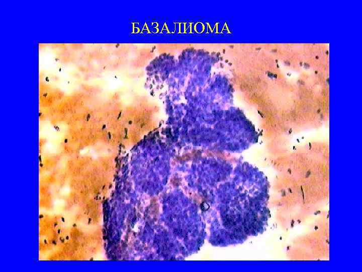 БАЗАЛИОМА 