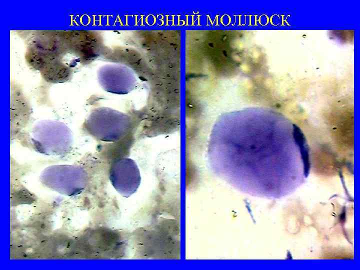 КОНТАГИОЗНЫЙ МОЛЛЮСК 