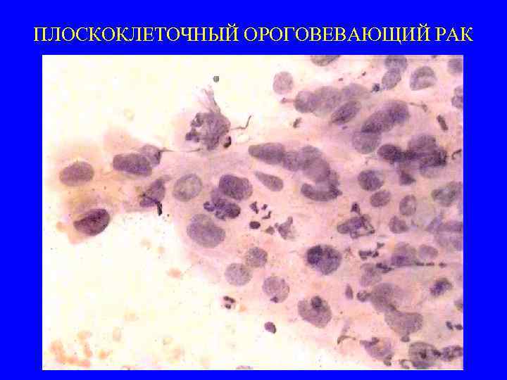 ПЛОСКОКЛЕТОЧНЫЙ ОРОГОВЕВАЮЩИЙ РАК 