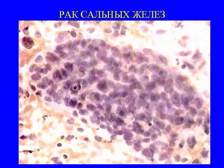 РАК САЛЬНЫХ ЖЕЛЕЗ 