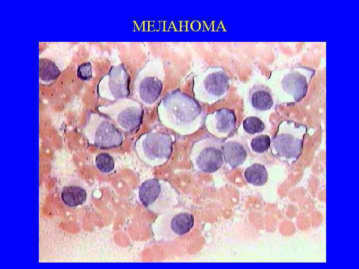 МЕЛАНОМА 