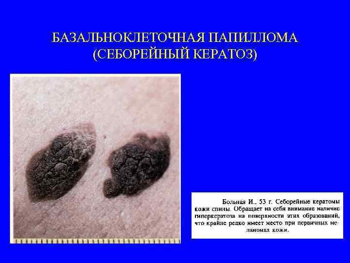 БАЗАЛЬНОКЛЕТОЧНАЯ ПАПИЛЛОМА (СЕБОРЕЙНЫЙ КЕРАТОЗ) 