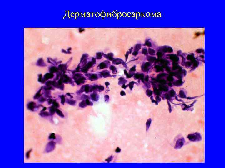 Дерматофибросаркома 