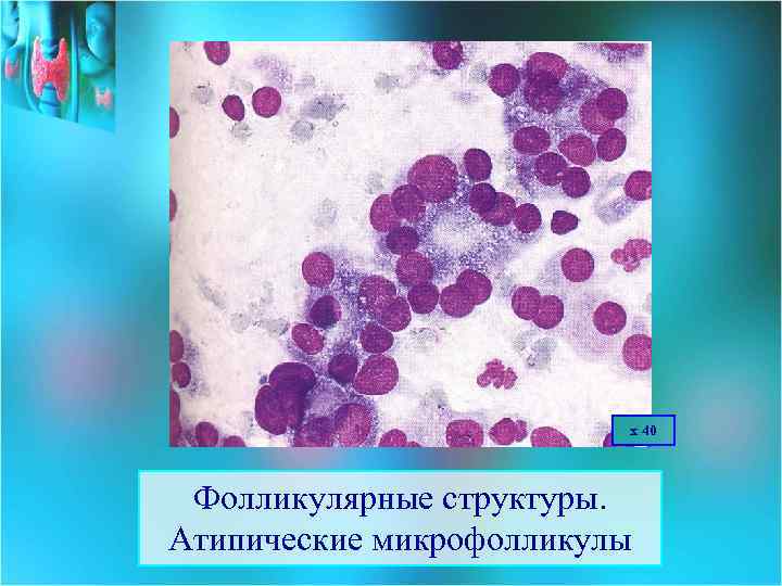 х 40 Фолликулярные структуры. Атипические микрофолликулы 