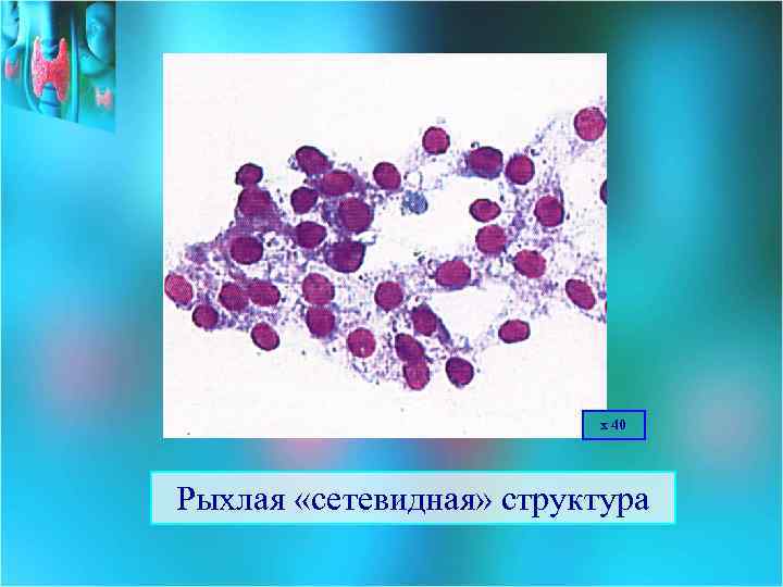 х 40 Рыхлая «сетевидная» структура 