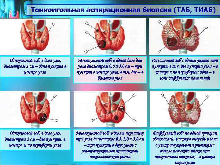 Тонкоигольная аспирационная биопсия (ТАБ, ТИАБ) Одноузловой зоб: в доле узел диаметром 1 см –