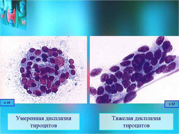 х 40 х 63 Умеренная дисплазия тироцитов Тяжелая дисплазия тироцитов 