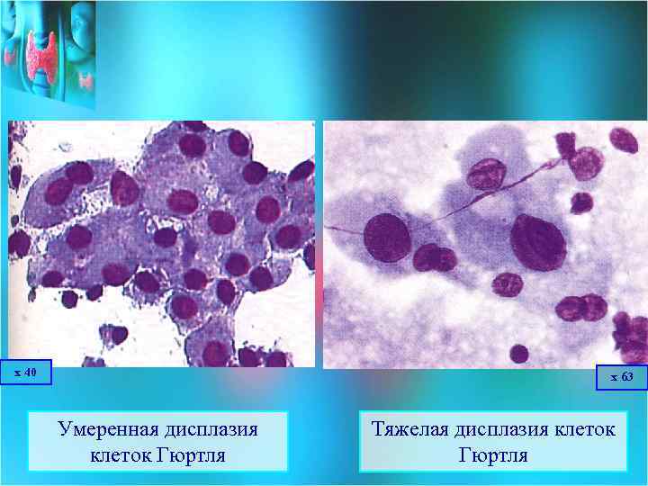 х 40 х 63 Умеренная дисплазия клеток Гюртля Тяжелая дисплазия клеток Гюртля 