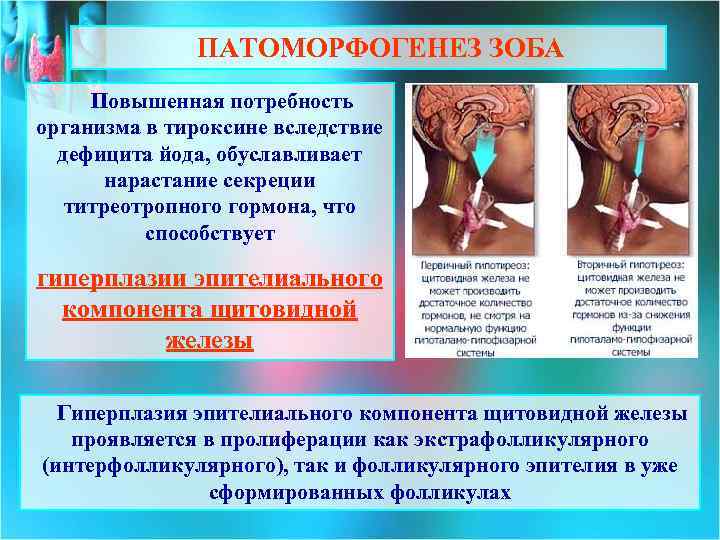 ПАТОМОРФОГЕНЕЗ ЗОБА Повышенная потребность организма в тироксине вследствие дефицита йода, обуславливает нарастание секреции титреотропного