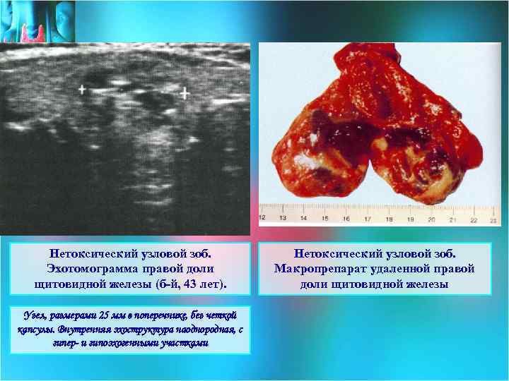 Нетоксический узловой зоб. Эхотомограмма правой доли щитовидной железы (б-й, 43 лет). Узел, размерами 25