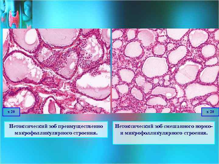 х 20 Нетоксический зоб преимущественно макрофолликулярного строения. х 20 Нетоксический зоб смешанного нормои микрофолликулярного