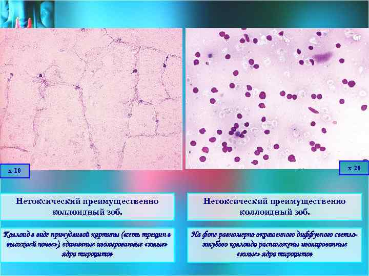 х 20 х 10 Нетоксический преимущественно коллоидный зоб. Коллоид в виде причудливой картины (