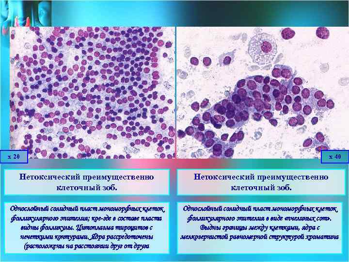 х 20 х 40 Нетоксический преимущественно клеточный зоб. Однослойный солидный пласт мономорфных клеток фолликулярного