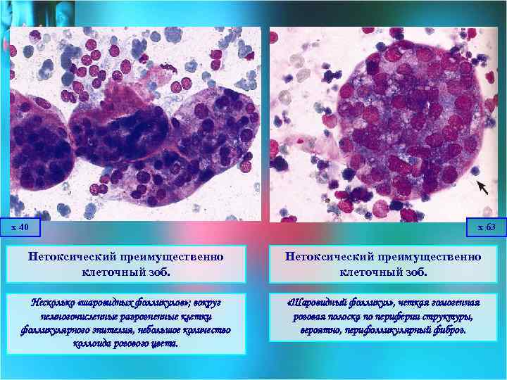 х 40 х 63 Нетоксический преимущественно клеточный зоб. Несколько «шаровидных фолликулов» ; вокруг немногочисленные