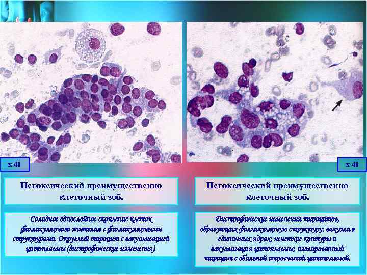 х 40 Нетоксический преимущественно клеточный зоб. Солидное однослойное скопление клеток фолликулярного эпителия с фолликулярными