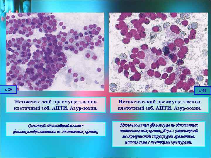 х 20 х 40 Нетоксический преимущественно клеточный зоб. АПТИ. Азур-эозин. Солидный однослойный пласт с