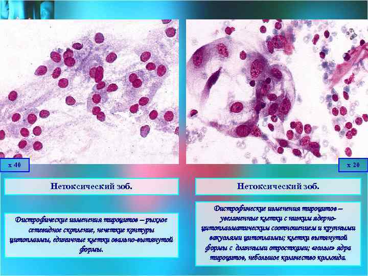 х 40 х 20 Нетоксический зоб. Дистрофические изменения тироцитов – рыхлое сетевидное скопление, нечеткие