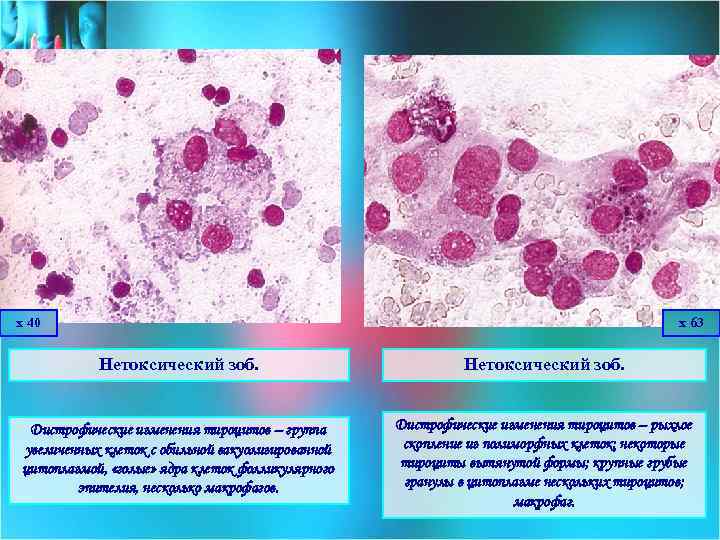 х 40 х 63 Нетоксический зоб. Дистрофические изменения тироцитов – группа увеличенных клеток с