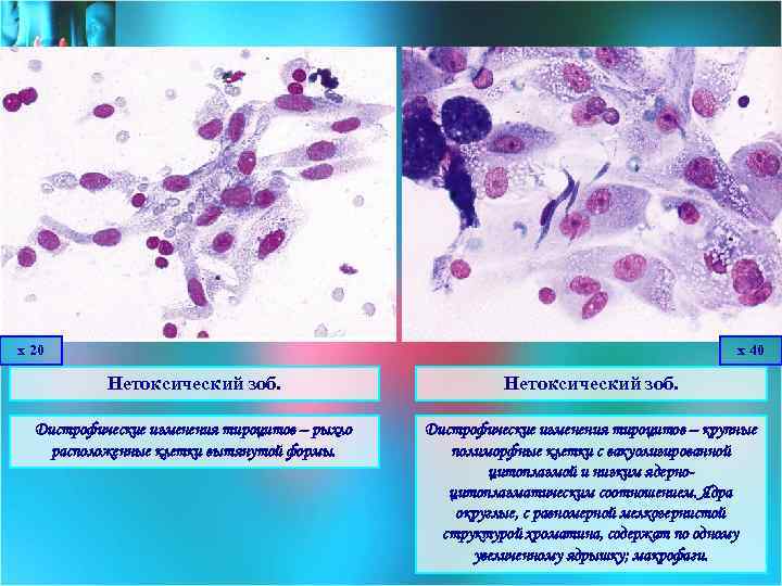х 20 х 40 Нетоксический зоб. Дистрофические изменения тироцитов – рыхло расположенные клетки вытянутой