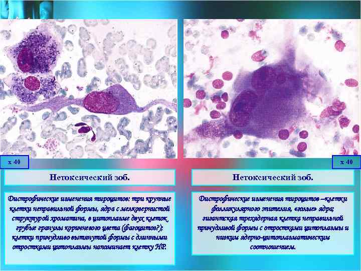 х 40 Нетоксический зоб. Дистрофические изменения тироцитов: три крупные клетки неправильной формы, ядра с