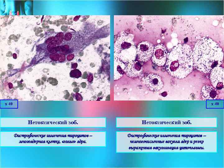х 40 Нетоксический зоб. Дистрофические изменения тироцитов – многоядерная клетка, «голые» ядра. Дистрофические изменения