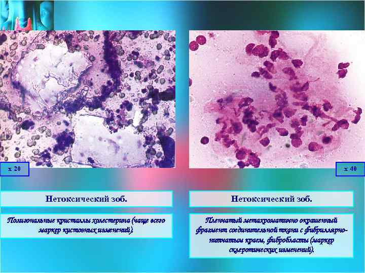 х 20 х 40 Нетоксический зоб. Полигональные кристаллы холестерина (чаще всего маркер кистозных изменений).