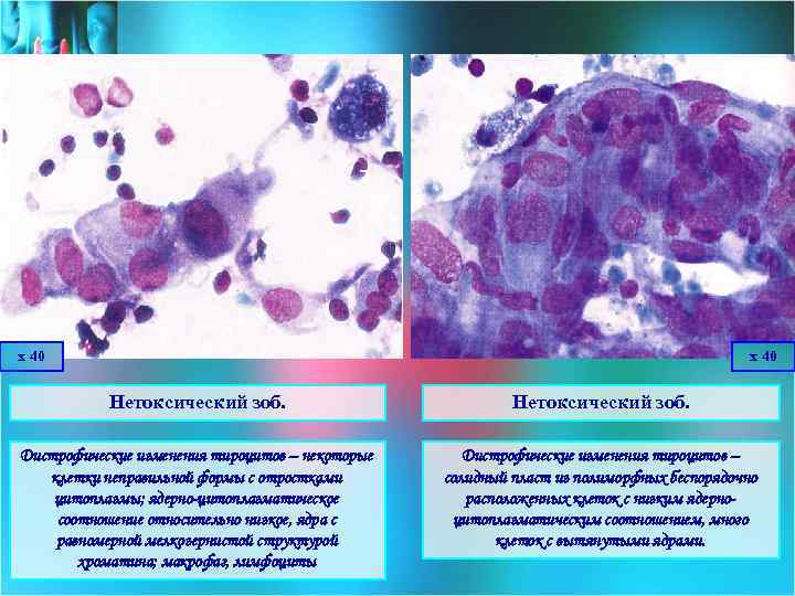 х 40 Нетоксический зоб. Дистрофические изменения тироцитов – некоторые клетки неправильной формы с отростками