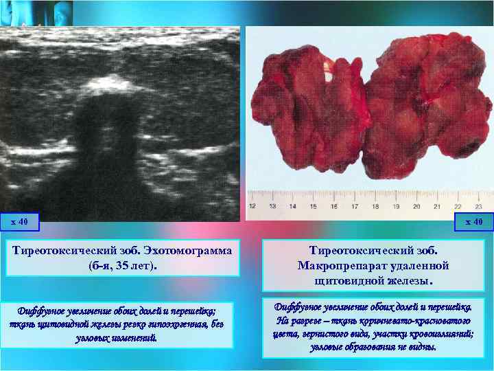 х 40 Тиреотоксический зоб. Эхотомограмма (б-я, 35 лет). Диффузное увеличение обоих долей и перешейка;