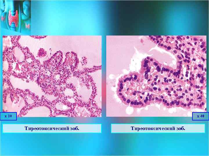 х 10 х 40 Тиреотоксический зоб. 