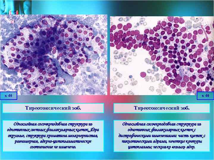 х 40 Тиреотоксический зоб. Однослойная сосочкоподобная структура из однотипных светлых фолликулярных клеток. Ядра округлые,