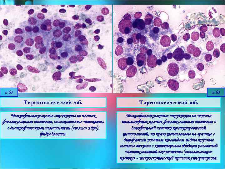 х 63 Тиреотоксический зоб. Микрофолликулярные структуры из клеток фолликулярного эпителия, изолированные тироциты с дистрофическими