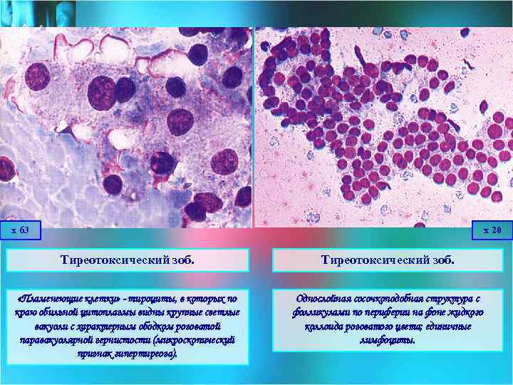 х 63 х 20 Тиреотоксический зоб. «Пламенеющие клетки» - тироциты, в которых по краю