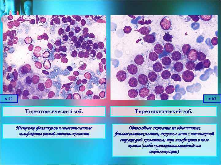 х 40 х 63 Тиреотоксический зоб. Несколько фолликулов и многочисленные лимфоциты разной степени зрелости