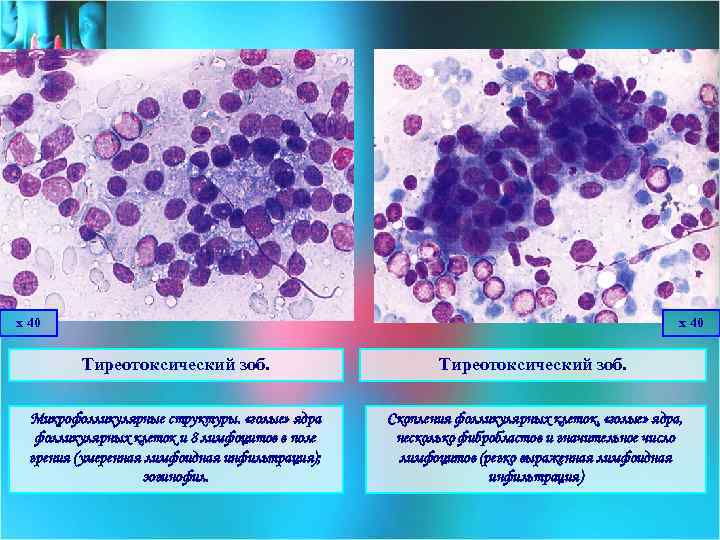 х 40 Тиреотоксический зоб. Микрофолликулярные структуры. «голые» ядра фолликулярных клеток и 8 лимфоцитов в