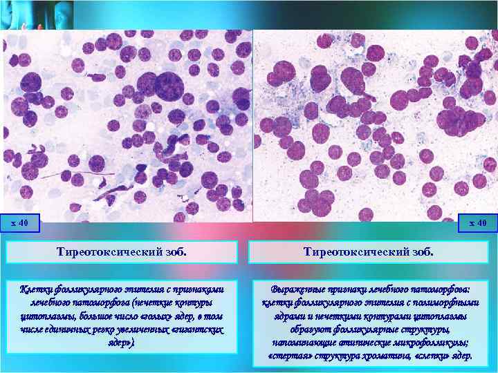 х 40 Тиреотоксический зоб. Клетки фолликулярного эпителия с признаками лечебного патоморфоза (нечеткие контуры цитоплазмы,