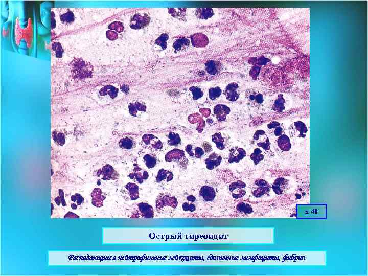 х 40 Острый тиреоидит Распадающиеся нейтрофильные лейкоциты, единичные лимфоциты, фибрин 