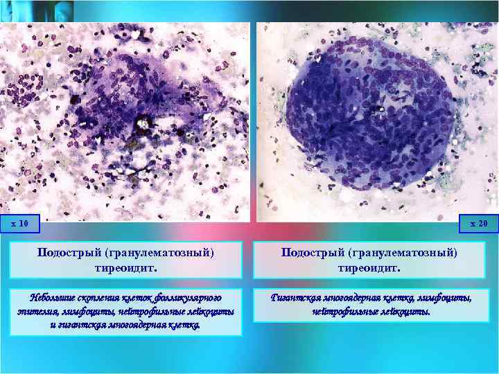 х 10 х 20 Подострый (гранулематозный) тиреоидит. Небольшие скопления клеток фолликулярного эпителия, лимфоциты, нейтрофильные