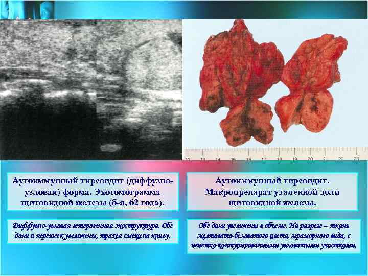 Аутоиммунный тиреоидит (диффузноузловая) форма. Эхотомограмма щитовидной железы (б-я, 62 года). Аутоиммунный тиреоидит. Макропрепарат удаленной