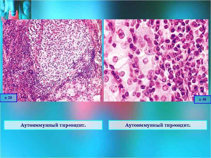 х 20 х 40 Аутоиммунный тиреоидит. 