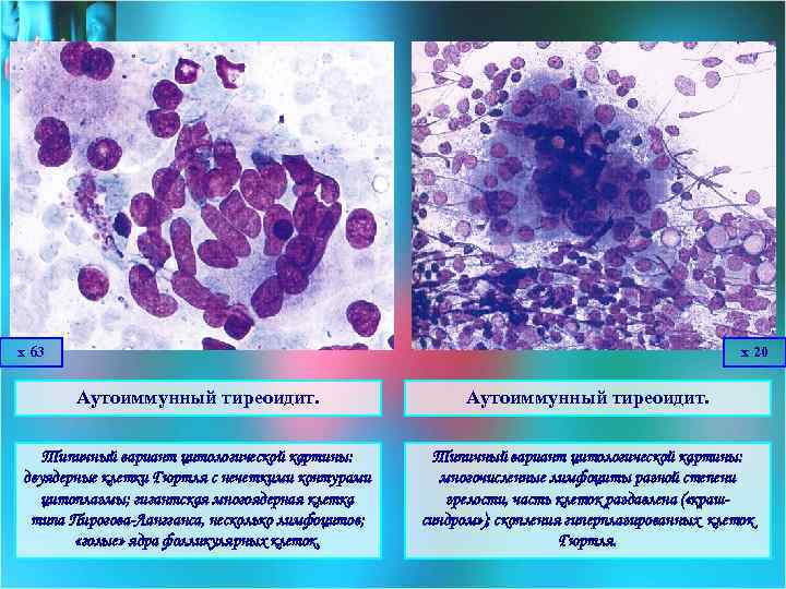 Цитологическая картина аутоиммунного тиреоидита