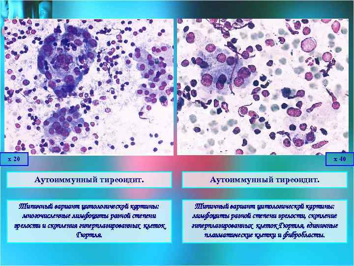 х 20 х 40 Аутоиммунный тиреоидит. Типичный вариант цитологической картины: многочисленные лимфоциты разной степени