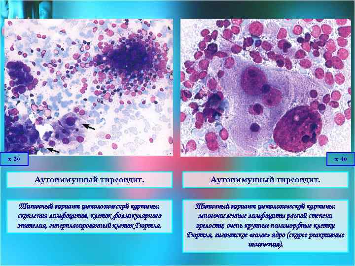 х 20 х 40 Аутоиммунный тиреоидит. Типичный вариант цитологической картины: скопления лимфоцитов, клеток фолликулярного