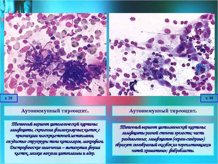 х 20 х 40 Аутоиммунный тиреоидит. Типичный вариант цитологической картины: лимфоциты, скопления фолликулярных клеток