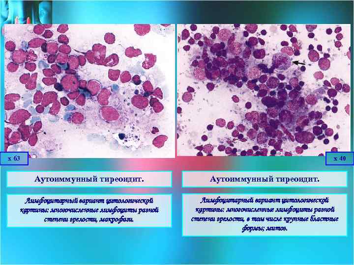 х 63 х 40 Аутоиммунный тиреоидит. Лимфоцитарный вариант цитологической картины: многочисленные лимфоциты разной степени