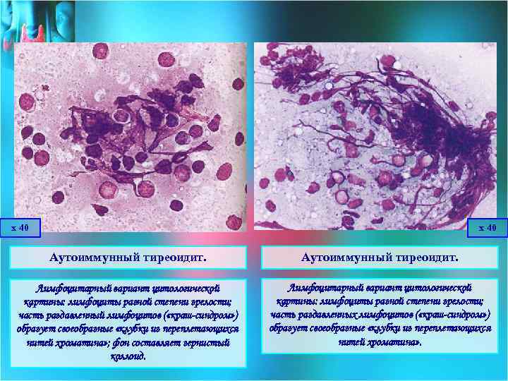х 40 Аутоиммунный тиреоидит. Лимфоцитарный вариант цитологической картины: лимфоциты разной степени зрелости; часть раздавленный