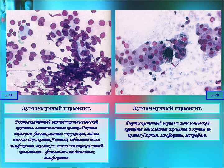 х 40 х 20 Аутоиммунный тиреоидит. Гюртлеклеточный вариант цитологической картины: многочисленные клетки Гюртля образуют