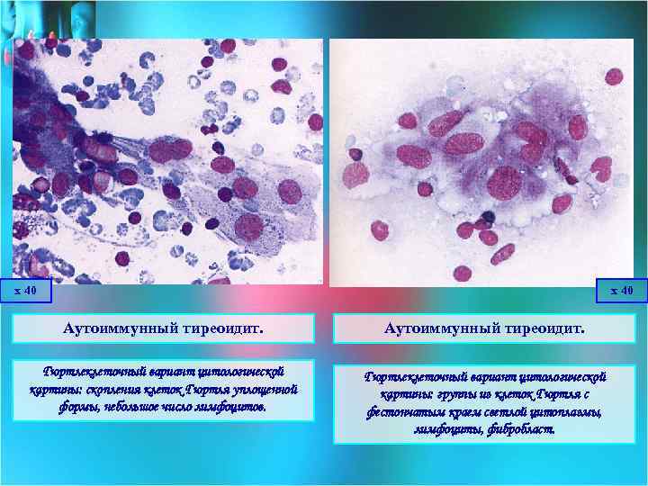 х 40 Аутоиммунный тиреоидит. Гюртлеклеточный вариант цитологической картины: скопления клеток Гюртля уплощенной формы, небольшое