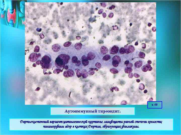 х 40 Аутоиммунный тиреоидит. Гюртлеклеточный вариант цитологической картины: лимфоциты разной степени зрелости; полиморфизм ядер