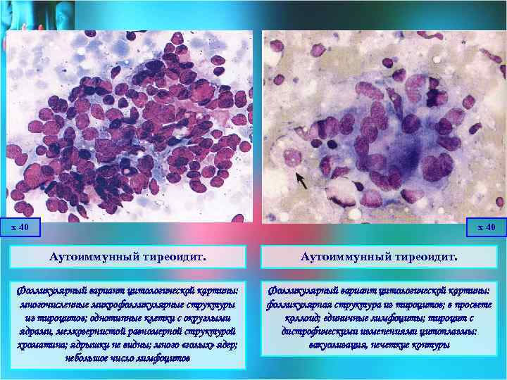 х 40 Аутоиммунный тиреоидит. Фолликулярный вариант цитологической картины: многочисленные микрофолликулярные структуры из тироцитов; однотипные