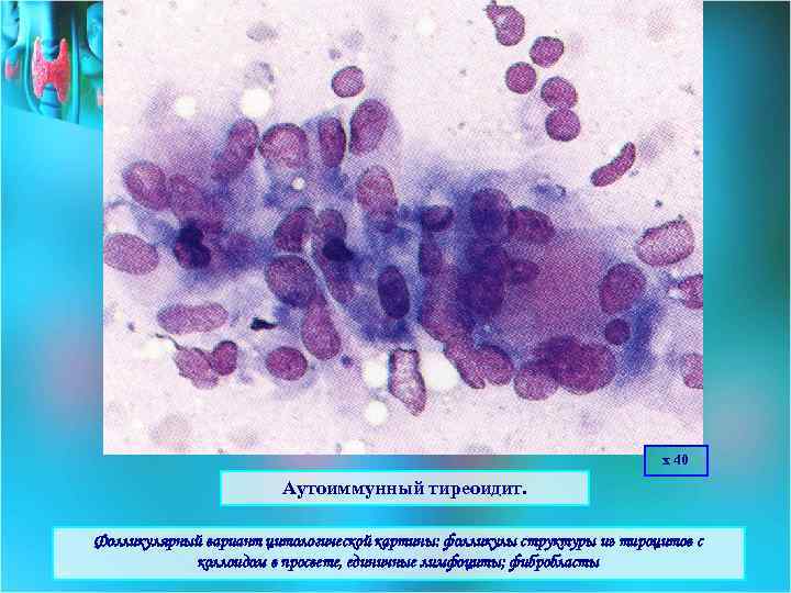 х 40 Аутоиммунный тиреоидит. Фолликулярный вариант цитологической картины: фолликулы структуры из тироцитов с коллоидом